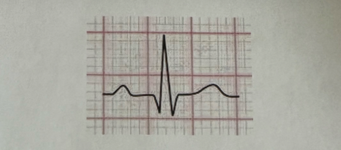 <p>Briefly describe placement of the lead used in the procedure that generates the image shown.</p>