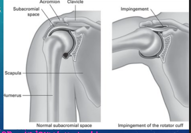 <p><strong>Impingement Syndrome: Background and S/S</strong></p><p>-______________ of the RTC muscles/bursa by the ___________</p><p>-_____________ impingement is the most common </p><p>-Mechanism of Injury:</p><ul><li><p>___________ use (overhead work), trauma, arthritis, and curved acromion</p></li></ul><p>-S/S:</p><ul><li><p>________ shoulder pain that is worse with _________ and internal rotation</p></li><li><p>Positive _____’_ and ___________ signs</p></li></ul><p></p>