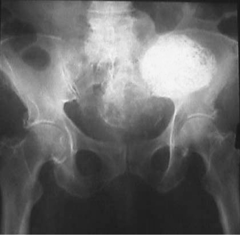 <p>calcification of uterine fibroids; located in pelvis</p>