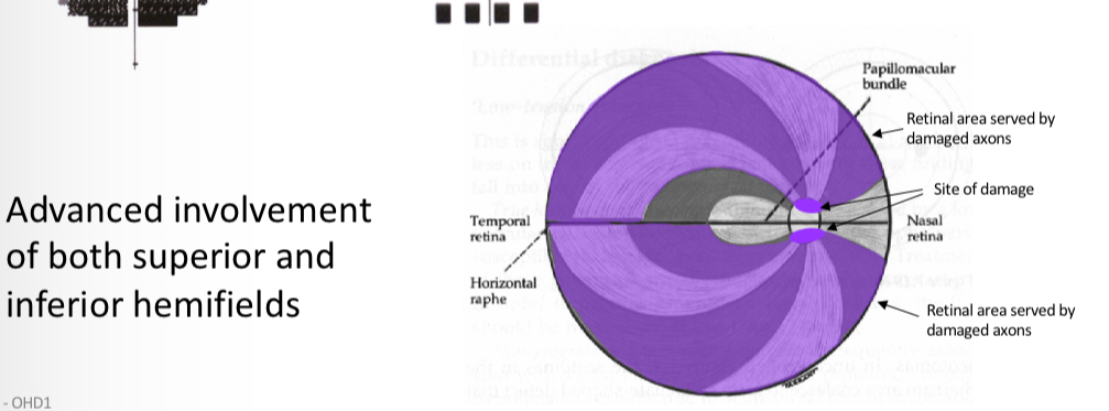 <p>Advanced glaucoma </p>