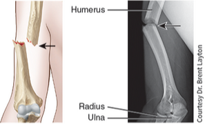 <p>The broken ends of the bone protrude through the skin. Conversely, a closed (simple) fracture does not break the skin.</p>