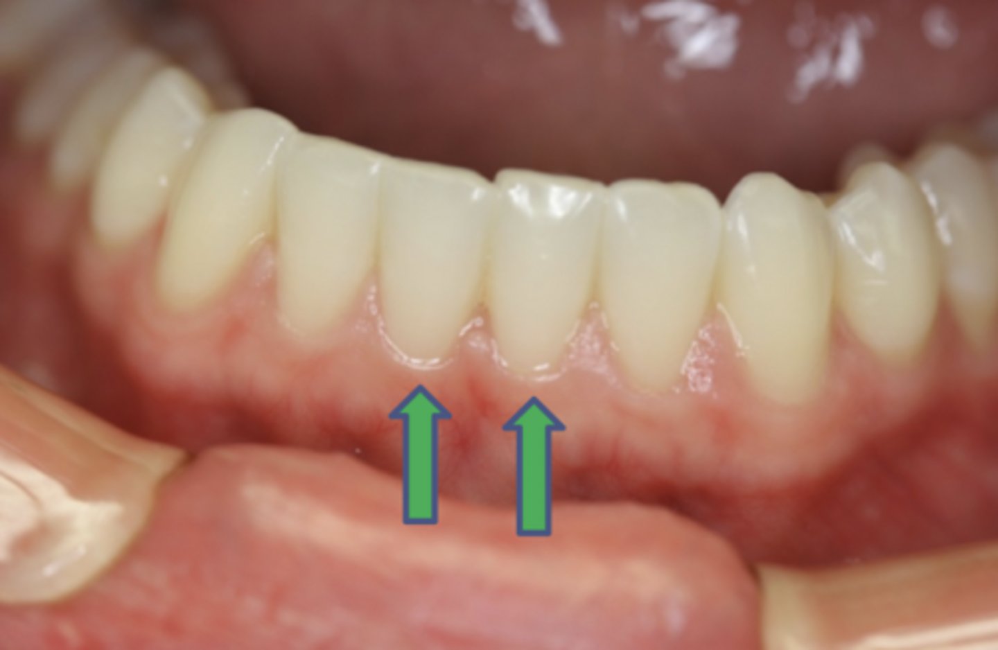 <p>- #24 and #25</p><p>- Eruption time = 6 to 7 years</p><p>- Root formation = 9 years</p><p>- Occludes with max. central incisors</p>