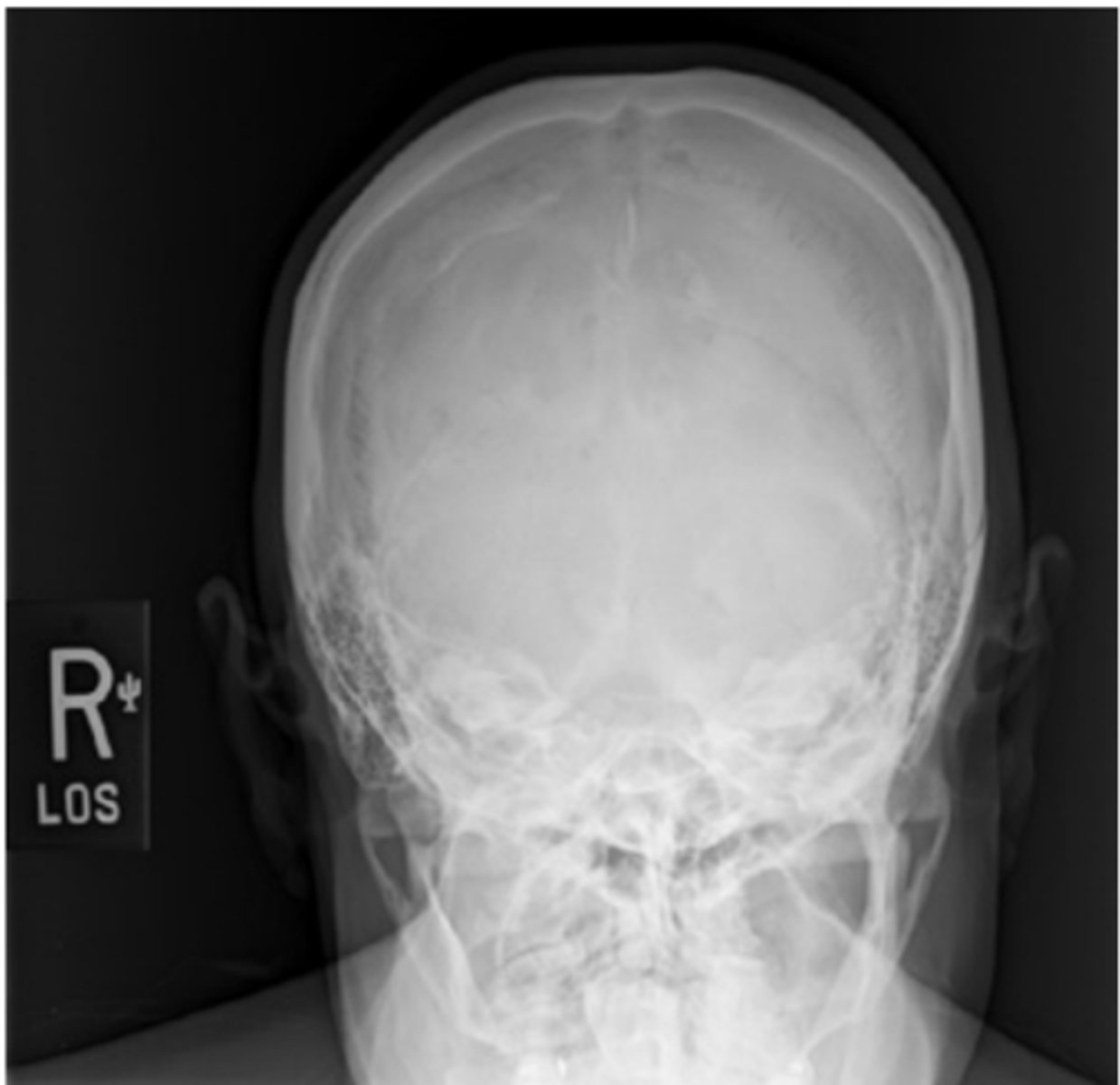 <p>-Position:</p><p>• Petrous ridges should be symmetric, indicating no rotation (petrous ridge will appear narrowed in the direction of rotation).</p><p>• Dorsum sellae and posterior clinoids visualized in the foramen magnum indicate correct CR angle and proper neck flexion/extension.</p><p>• Underangulation of CR or insufficient flexion of neck projects the dorsum sellae superior to the foramen magnum. Overangulation of CR or excessive neck flexion superimposes the posterior arch of C1 over the dorsum sellae within the foramen magnum and produces foreshortening of the dorsum sellae.</p><p>• Shifting of the anterior or posterior clinoid processes laterally within the foramen magnum indicates tilt</p>