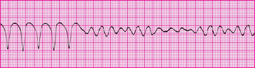<p>A witnessed change in any cardiac rhythm, including starting, stopping or both; for ex- sinus rhythm to SVT or Ventricular Tach to Ventricular fibrillation</p>