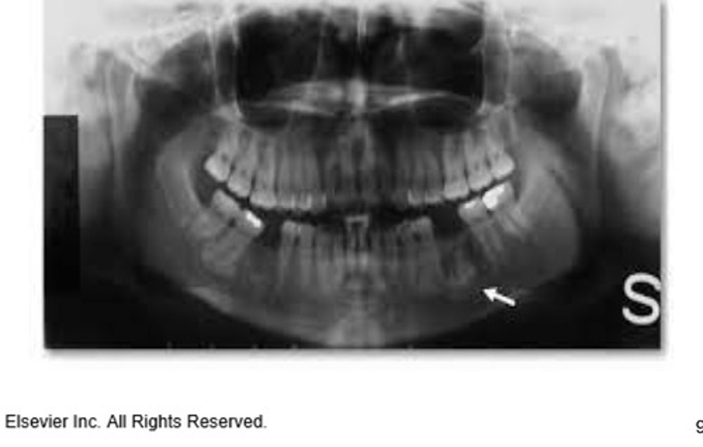 <p>An asymptomatic meningitis tumour composed of benign compact bone. Radiographically: appears as an either a sharply delineated radiopaque mass within a bone or attached to outer surfaces of bone.</p>