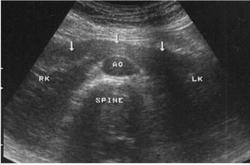 <p>Which type of analomy is shown in this image→ ?</p>
