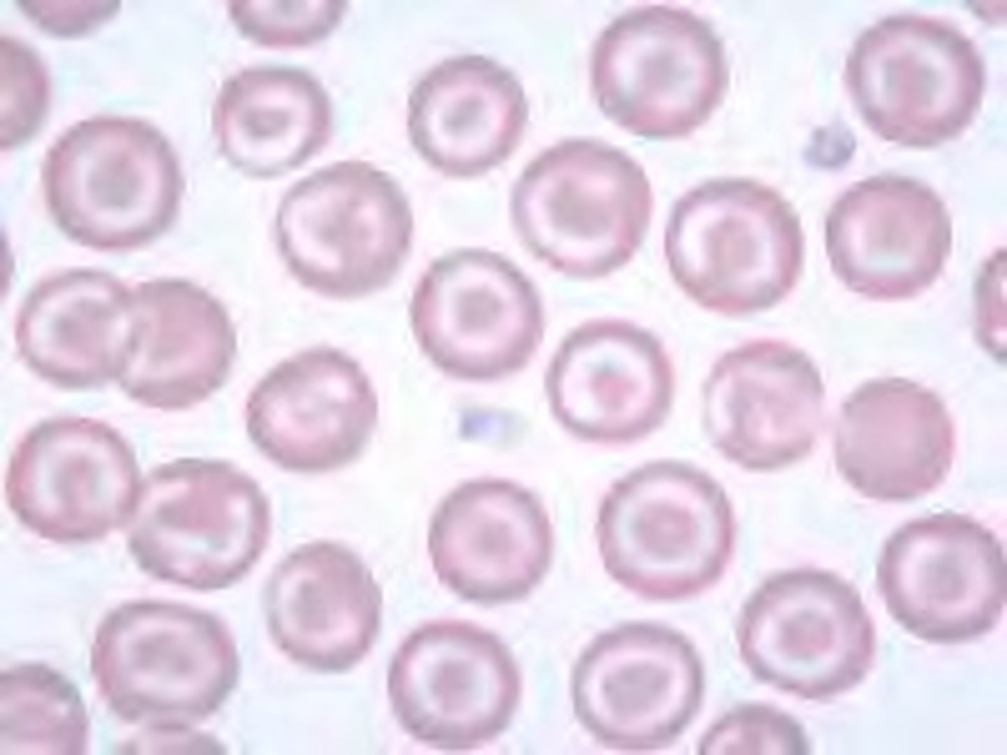 <p>Liver disease</p>