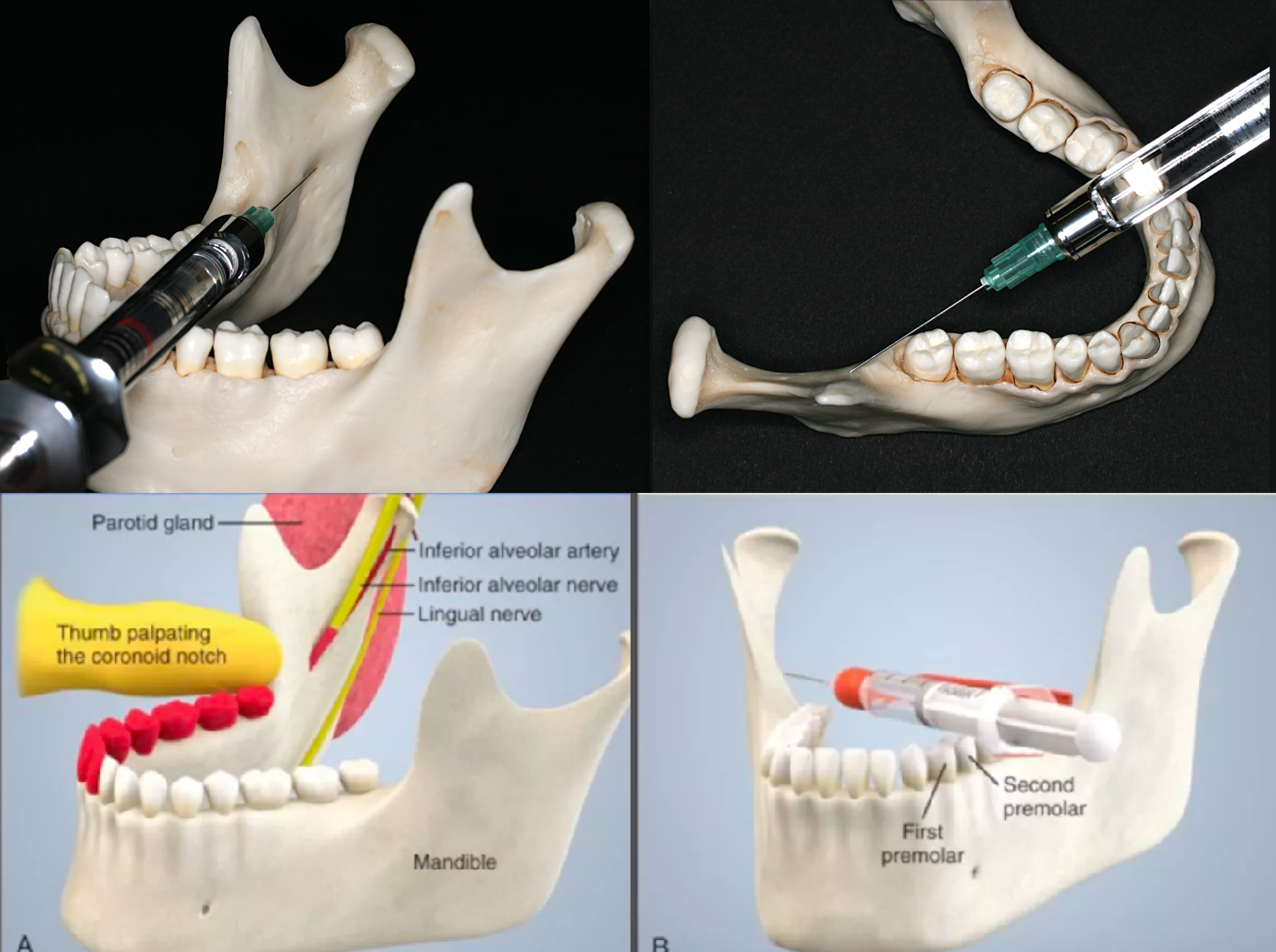 <ul><li><p>Come in from the <strong>contralateral</strong> side between the premolar area</p></li><li><p>Slowly advance until bone is contacted</p></li><li><p>Average depth of insertion: 20-25 mm ~ 2/3rd needle size</p></li></ul><p></p>