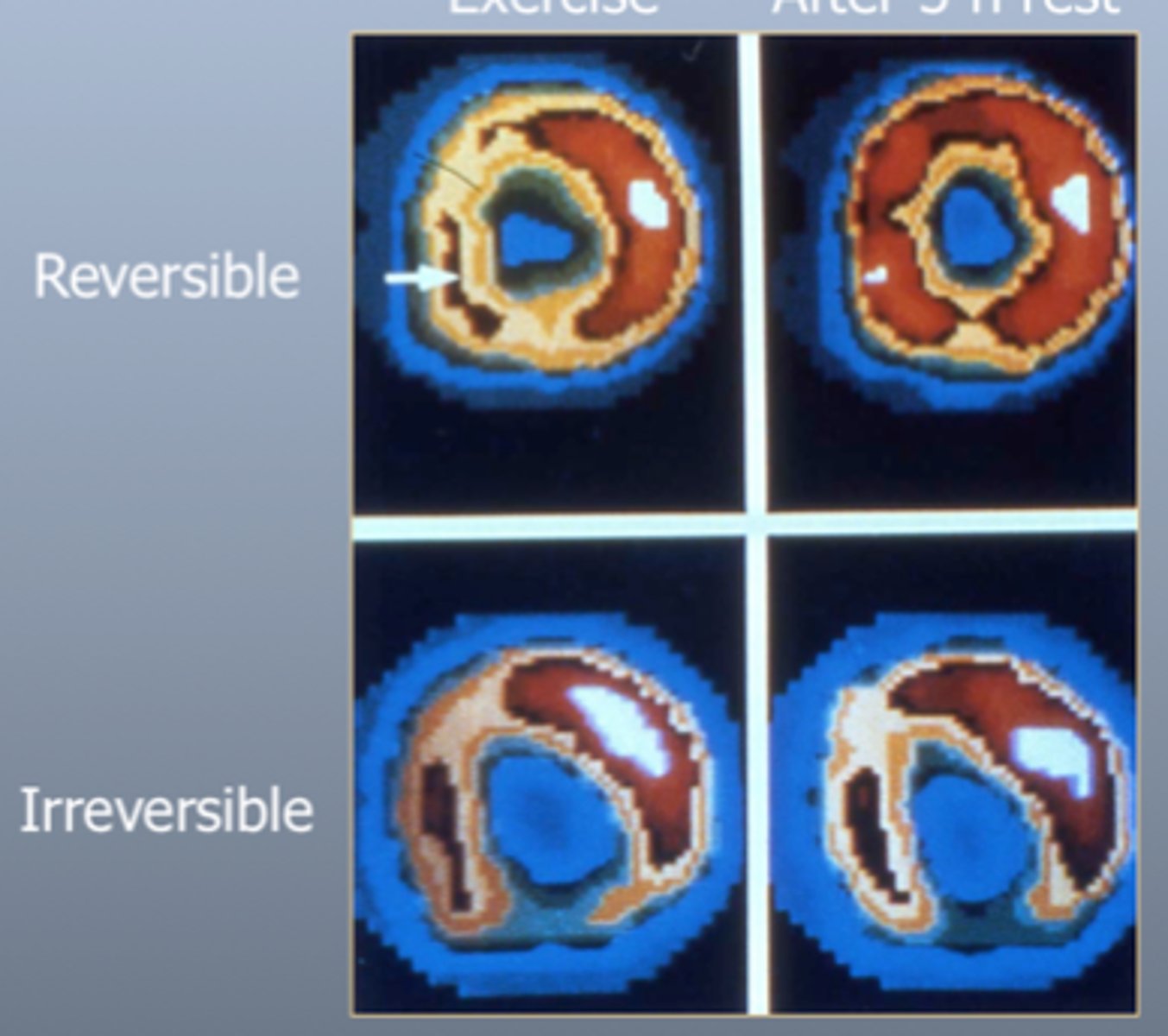 <p>-Thallium-201 injected via IV to evaluate heart (myocardial) perfusion</p><p>-Lack of uptake of thallium-201 in areas of the heart with infarcted or scarred myocardium</p>