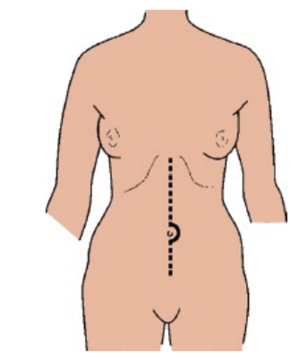 <p>incision down the middle of the abdomen along and<span style="color: red;"><strong> through the linea alba</strong></span></p><p>Surgical work-horse in adults</p>