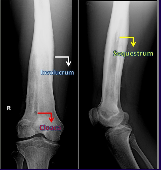 <p>In this image of osteomyelitis, define the labels.</p>