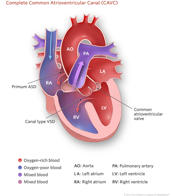 <p><strong><u>Increased</u> Pulmonary Blood Flow</strong></p><ul><li><p class="">Failure of endocardial cushions to fuse.</p></li><li><p class="">Tricuspid and mitral valves do not get separated.</p></li><li><p class="">ASD and VSD are present.</p></li><li><p class="">Left to right shunting.</p></li><li><p class="">Pulmonary edema.</p></li><li><p class="">Often associated with Trisomy 21.</p></li><li><p class="">Difficulty breathing, poor weight gain and growth, cyanosis, heart murmur.</p></li></ul><p></p>