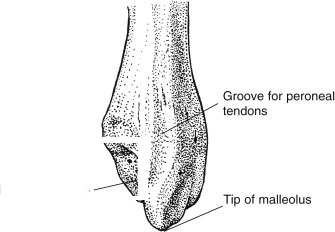 <p>What feature of the fibula is this?</p>