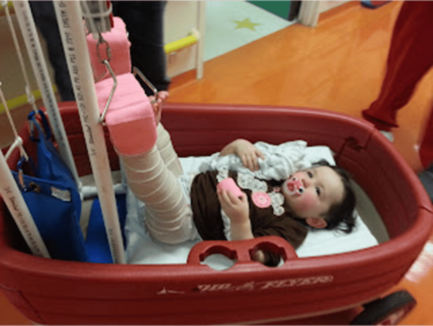 <p>•Used primarily for young children with femur fractures or developmental dysplasia of the hip (DDH).</p><p>•It helps maintain proper alignment of the hip and femur before surgery or casting.</p><p>•The child lies flat on their back in bed.</p><p>•Both legs are suspended at a 90-degree angle to the hips.</p><p>•The hips are slightly lifted off the bed to maintain traction.</p><p>•The weights provide gentle, continuous pulling force to align the femur or hip joint.</p><p>Nursing Care</p><p>•Perform frequent neurovascular checks (6 Ps).Check capillary refill, skin temperature, and pedal pulses.</p><p>•Maintain Proper Positioning</p><p>•Ensure hips remain at 90 degrees.</p><p>•Keep buttocks slightly off the bed, not resting fully.</p><p>•Make sure weights hang freely and are not touching the floor.</p><p>•Assess skin under the traction straps for irritation or breakdown.</p><p>•Change diapers frequently to prevent skin breakdown.</p><p>•Perform range-of-motion exercises for the upper body to prevent stiffness.</p><p>•Administer analgesics as prescribed for pain relief.</p><p>•Provide age-appropriate activities to prevent boredom.</p>