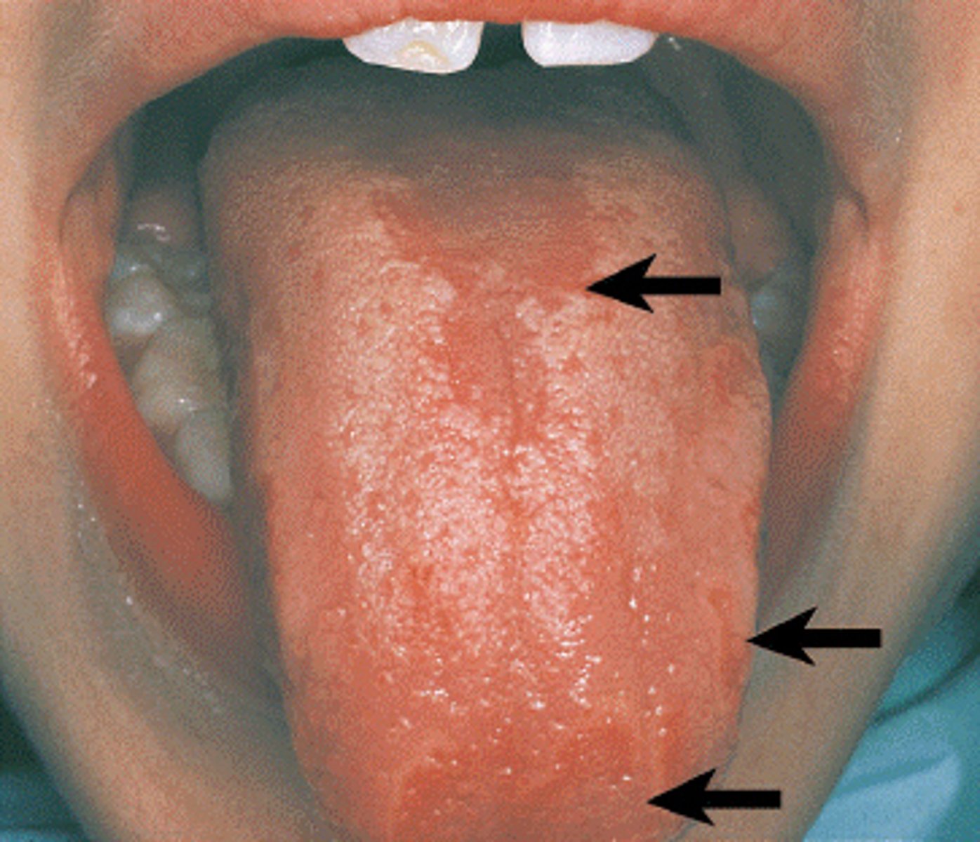<p>The pathologic lesion seen on the dorsal surface of the tongue is characteristic of</p><p>A.fissured tongue.</p><p>B.hairy tongue.</p><p>C.median rhomboid glossitis.</p><p>D.migratory glossitis.</p>