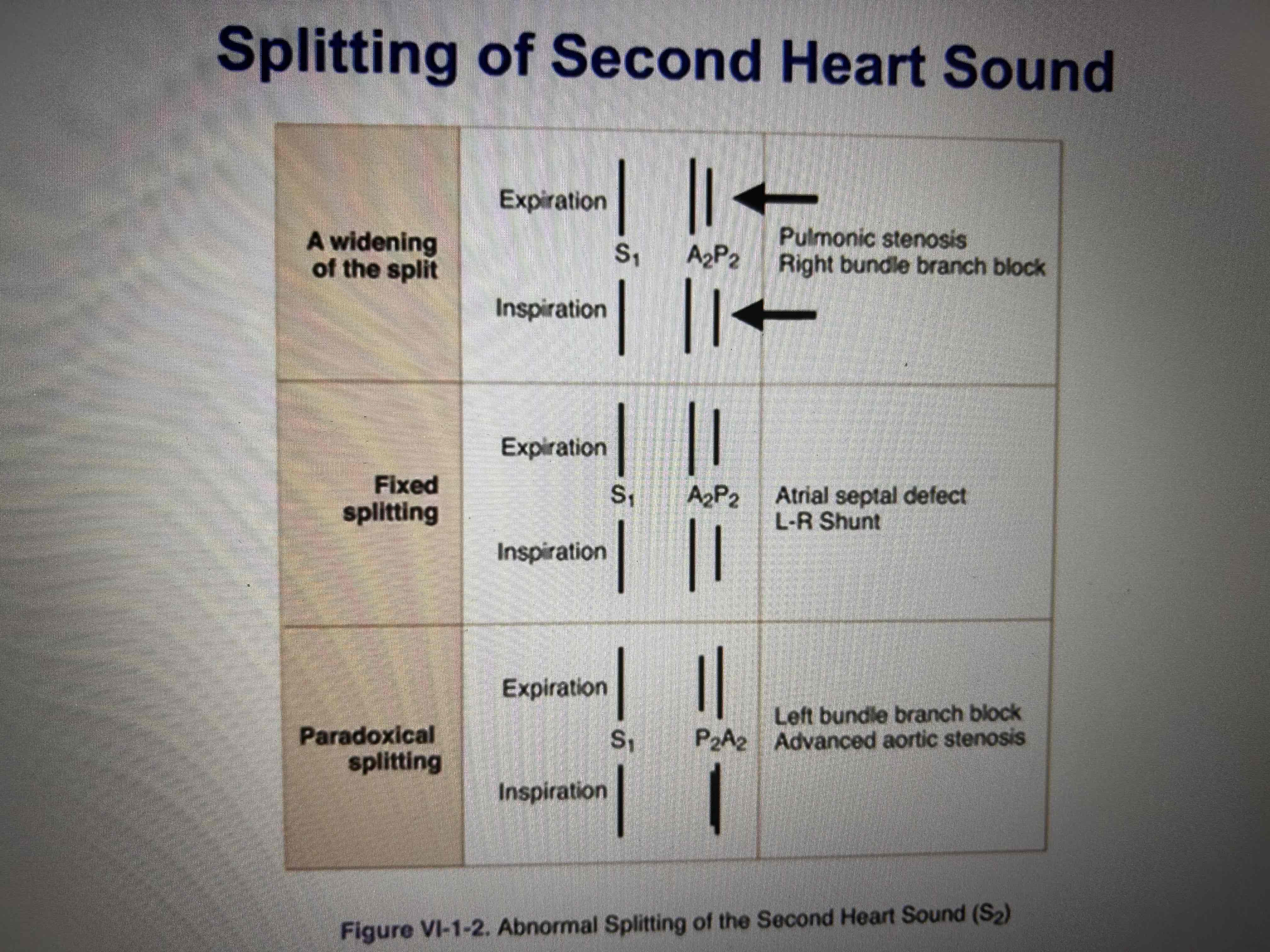 <p>S1-mitral and tricuspid valves closure</p><p>S2- closure of the aortic and pulmonic valves ( during inspiration-physiological splitting, right heart delayed)</p><p></p>
