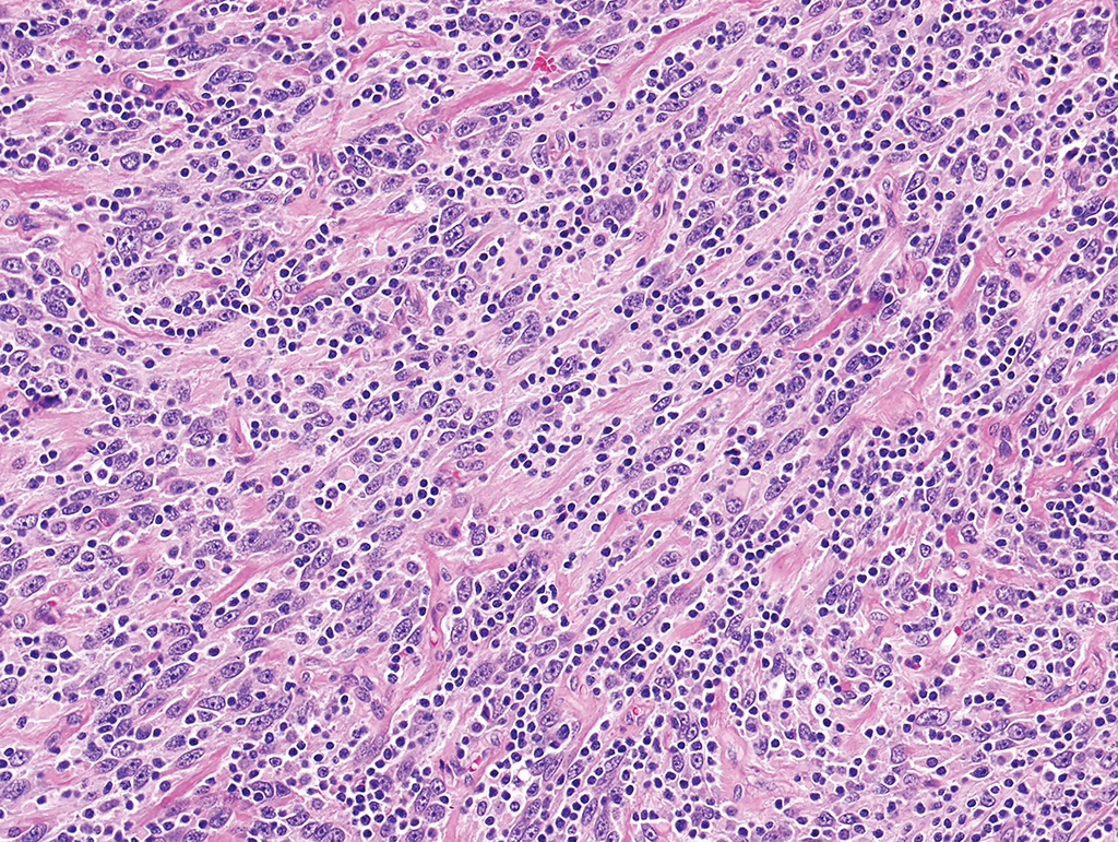 <p>Patient de 50 ans, masse ORL </p><p>1) Diagnostic </p><p>2) localisation</p><p>3) Histo</p><p>4) IHC </p>