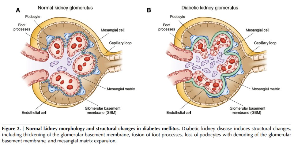<ol><li><p>Hyperglycemia means that more glucose is filtered by the glomerulus<br>- proximal tubules reabsorb more glucose and sodium, <strong>reducing sodium delivery to macula densa</strong> (the cells that sense flow); → tricks the macula densa into thinking the filtration is too low → afferent arteriole <strong>dilates</strong>, <strong>increasing glomerular pressure</strong>, and leading to hyperfiltration</p></li><li><p>Chronic hyperglycemia → formation of advanced glycation end-products (AGEs) which damage:</p><ul><li><p>mesangial cells, leading to expansion of mesangial cells</p></li><li><p>glomerular basement membrane, leading to thickening and scarring</p></li><li><p>end result: leakier glomeruli → albumin leaks out, leading to albuminuria</p></li></ul></li><li><p>Podocyte injury -<strong> high glucose leads to podocyte apoptosis and detachment</strong>, which leads to increased <strong>proteinuria</strong>, esp <strong>albuminuria</strong></p></li><li><p>Glomerulosclerosis - all of the above lead to progressive scarring and decreased filtration</p></li><li><p>tubulointerstitial fibrosis - chronic protein leakage + inflammation → damage to tubules and interstitium → loss of nephron function over time</p></li></ol><p></p><p></p><p></p><ul><li><p></p><img src="https://knowt-user-attachments.s3.amazonaws.com/c238524c-fe5d-4e16-928d-e78d27b35130.png" data-width="100%" data-align="center"></li></ul><p></p>