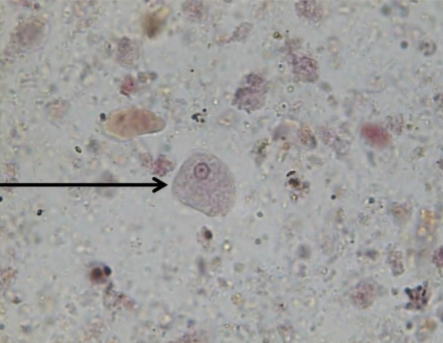 <p>MOT: Fecal / Oral (ingestion of cyst)</p><p>Infective stage: Cyst</p><p>Hosts: Human</p><p>Parts to look for: small bullseye nucleus & central karyosome</p>