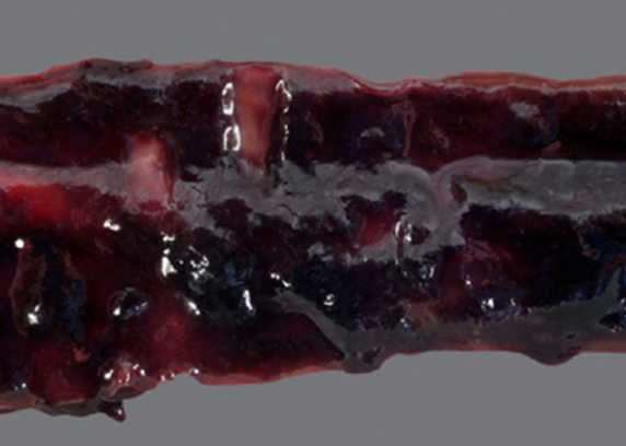 <p>-acute necrotizing and neutrophilic enterocolitis</p><p>-no association with diet change/dietary indiscretion</p><p>-in some cases, enterotoxemia due to <em>clostridium perfingens </em>(netF toxin gene)</p>