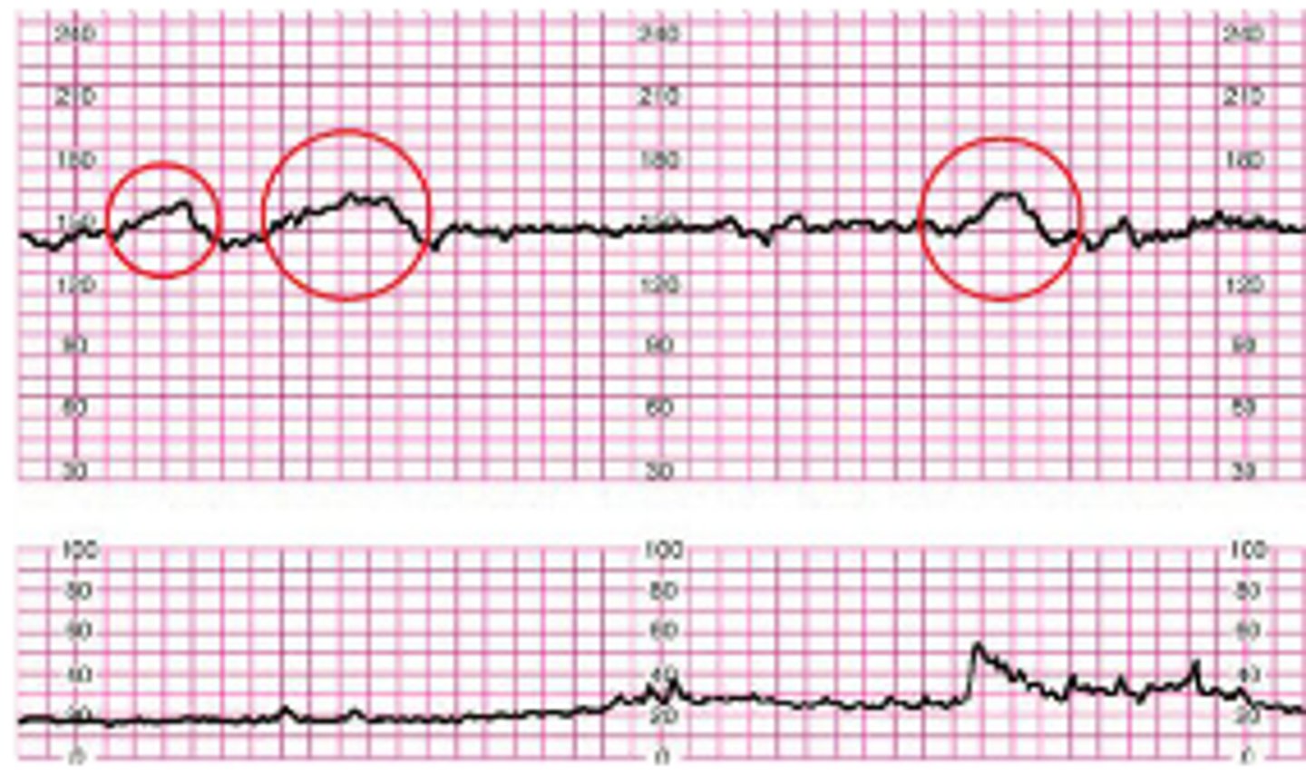 <p>VEAL CHOP</p><p>High FHR - Okay</p><p>No interventions</p><p>Shows random upward bumps on FHR monitor</p>