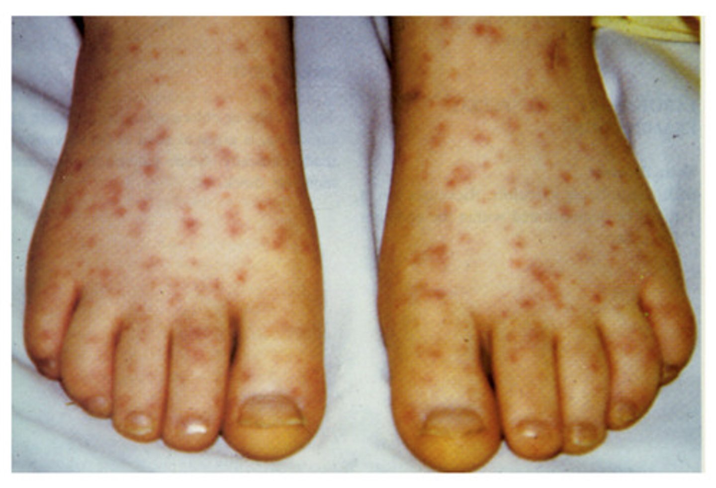 <p>Rickettsia rickettsii</p><p>transmitted by dermacentor ticks</p><p>signs: fever, bruising/bleeding, lymphadenopathy</p><p>not a true zoonotic disease but can catch it if bitten</p>
