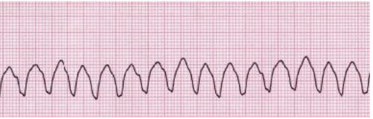 <p>A sleep disorders specialist notes the following cardiac rhythm during the first REM period of an overnight PSG. Which of the following should the specialist do next?</p>