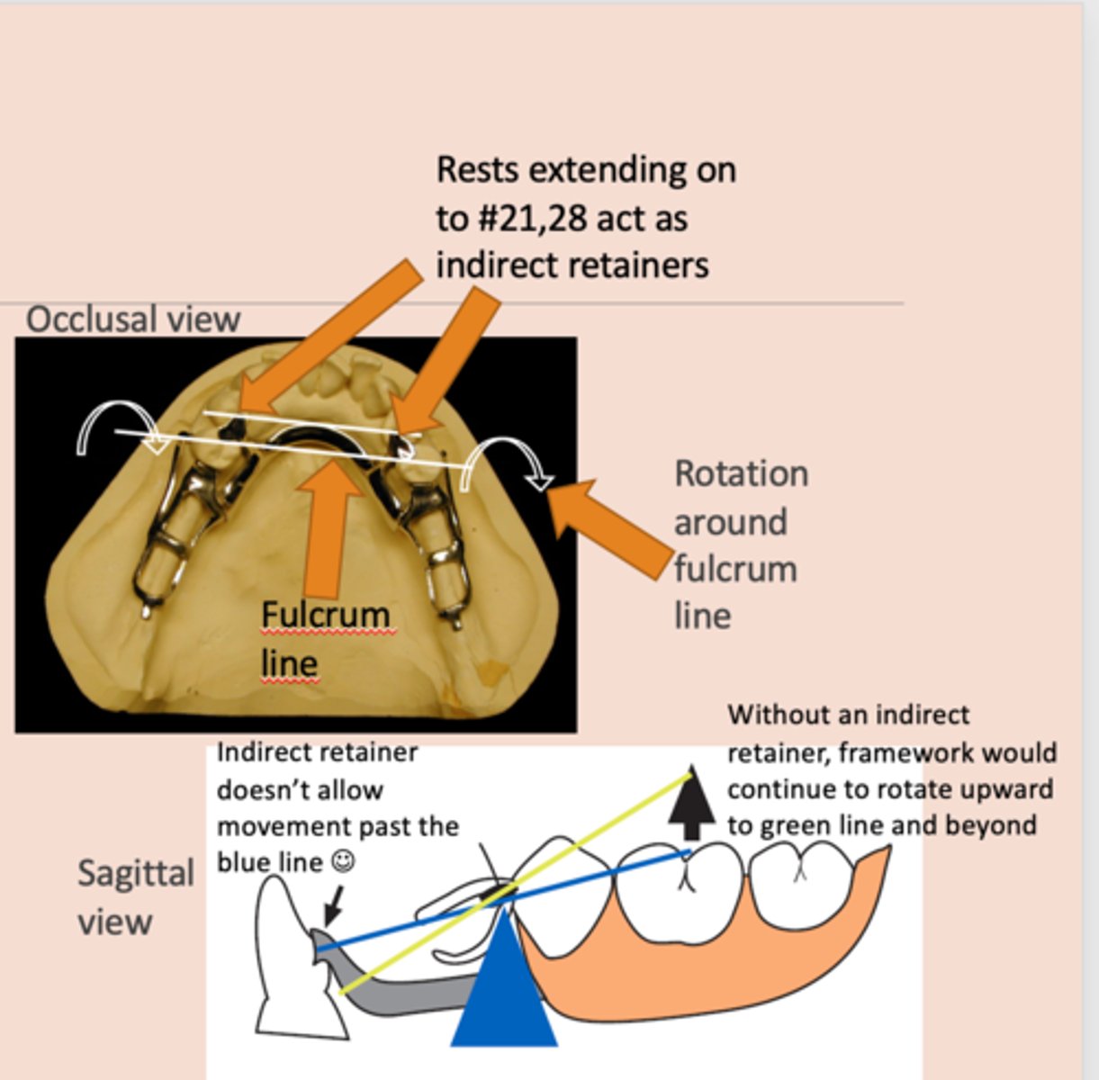 <p>associated with extension base RPDs, </p><p>rotation occurs around rests: fulcrum line is through the most distal rest on each side, assist the direct retainers in preventing displacement through lever action on the opposite side of the fulcrum line when the denture base moves away from the tissues in rotation around the fulcrum line, prevents rotational displacement of denture from supporting soft tissues</p>