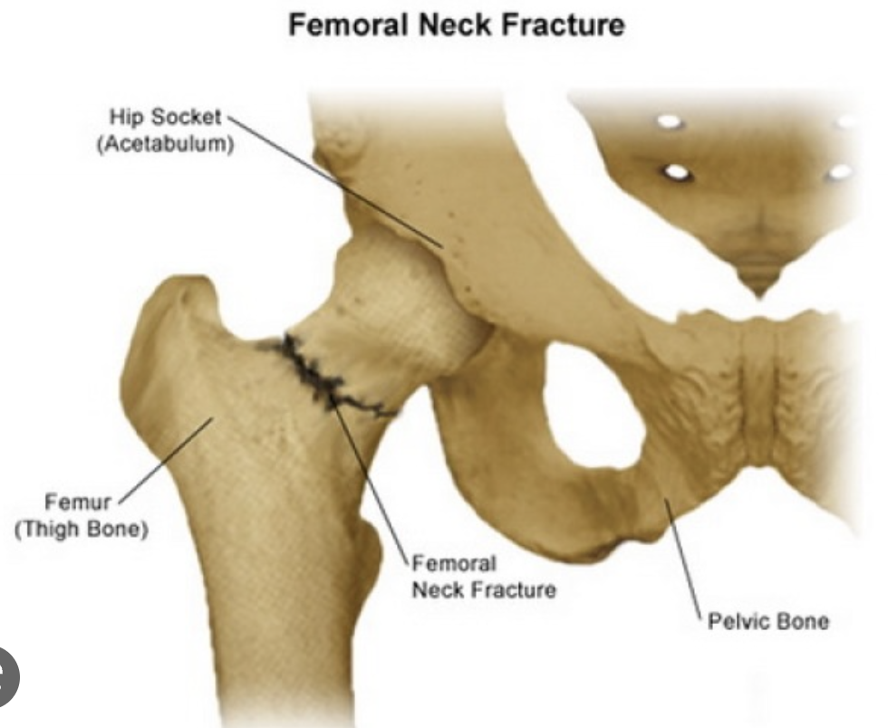 The femoral neck; can fracture in relation to osteoporosis
