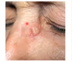 <p>squamous cell carcinoma </p>