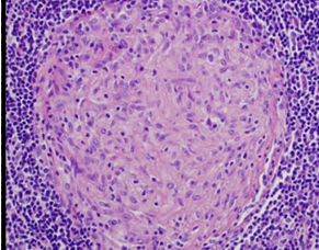 <p>a group of macrophages that surround and digest inanimate foreign bodies that are too large to be engulfed by a single macrophage</p><p>contains lymphocytes, macrophages, and fibroblasts</p>
