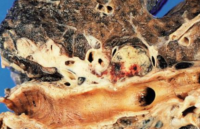 <p>Carcinoma de células pequeñas, dónde pueden surgir los tumores</p>