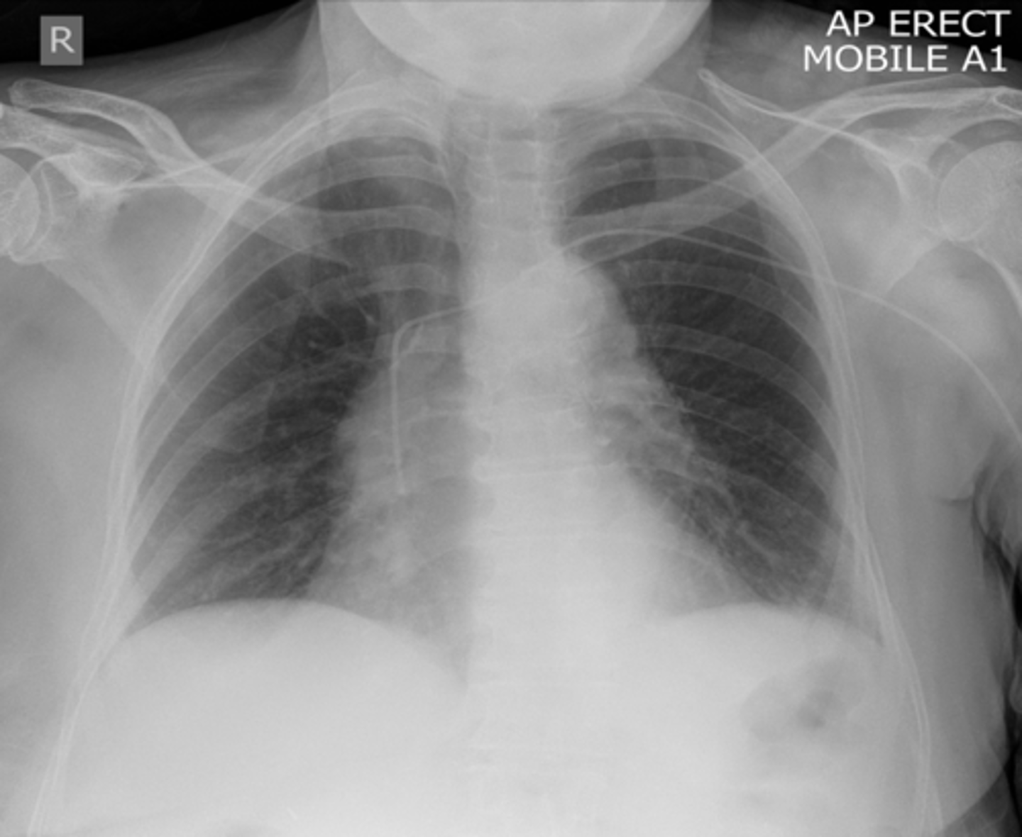 <p>-tip in SVC</p><p>-hard to see</p>