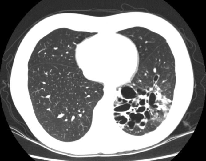 <p>Bronchiectasis CT Scan</p>