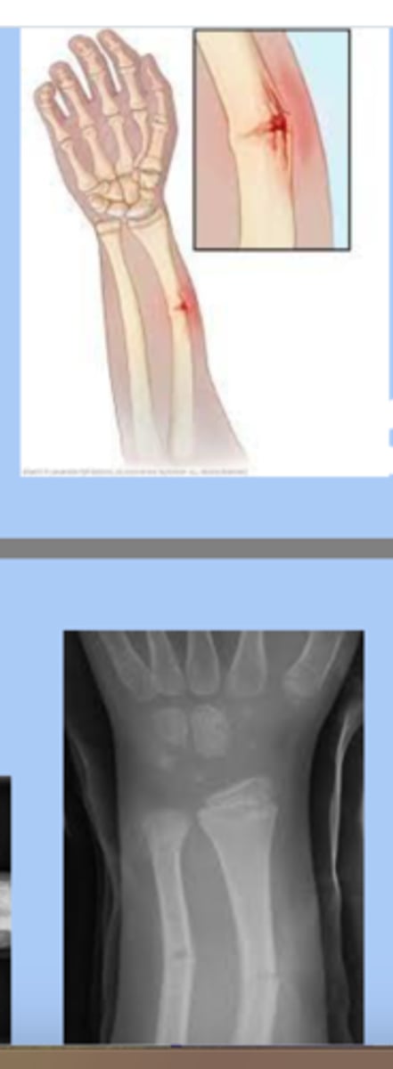 <p>-frank disruption of the cortex on one side of the bone but no discernible cleavage plane on the opposite side </p><p>-txL reduction and casting, repeat XR -7-10 days </p>