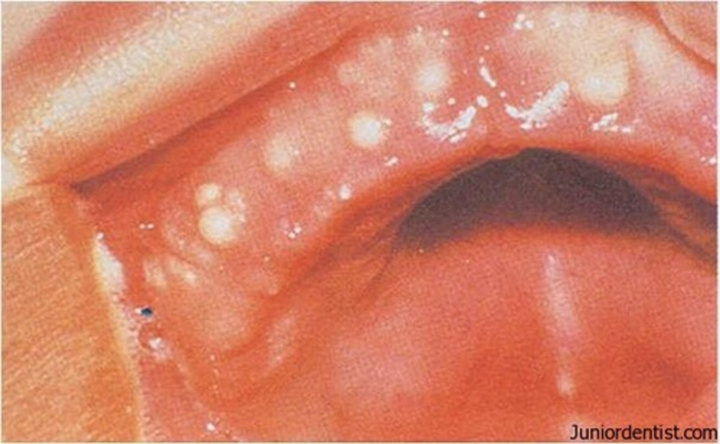 <p>white/yellow cysts on hard palate</p>