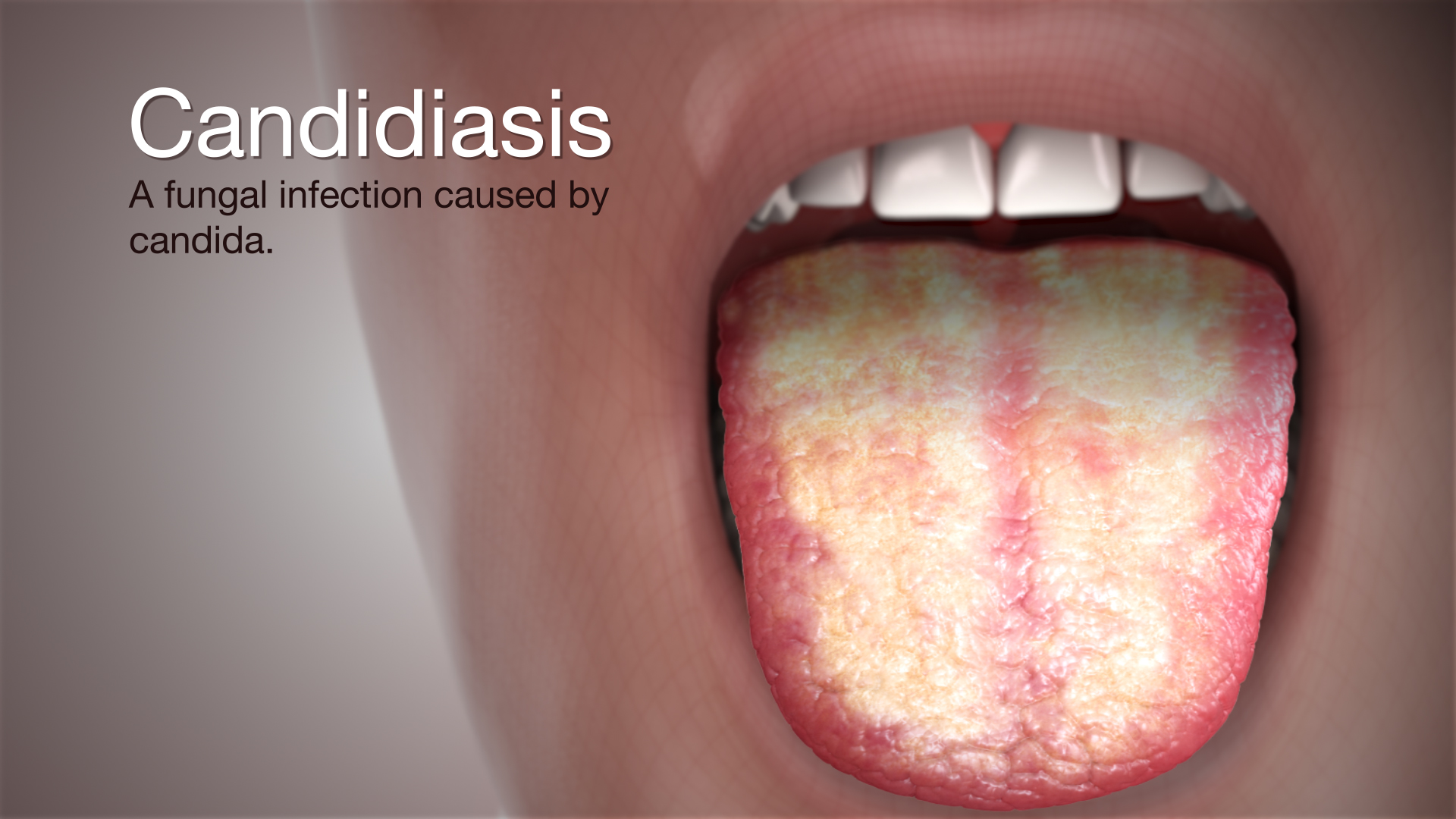 <p>E: yeast<br>abx<br>diabetes<br>obesity<br>poor hygiene<br>oral infxn (1st sx of HIV)<br>warm/moist areas</p><p>CM:<u><br>oral:</u> whitish plaques on erythematous base of buccal mucosa (thrush)</p><p><u>body:</u><br>beefy/red papules/plaques in skin folds (interigo)<br>satellite lesions<br>thick “cheesy” discharge</p><p>TX:<br><u>oral:</u><br>nystatin suspension<br>fluconazole<br>breastfeeding→tx mother’s nipples</p><p><u>body:</u><br>keep area dry+clean<br>stop mx<br>topical/PO antifungals</p>
