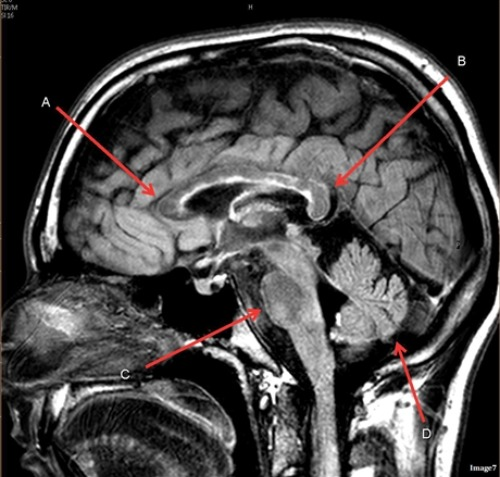 <p>Letter B in Image 7 is pointing to:</p><p>A. Pons</p><p>B. Cerebellum</p><p>C. Hypothalamus</p><p>D. Genu of the corpus callosum</p><p>E. Splenium of the corpus callosum</p>