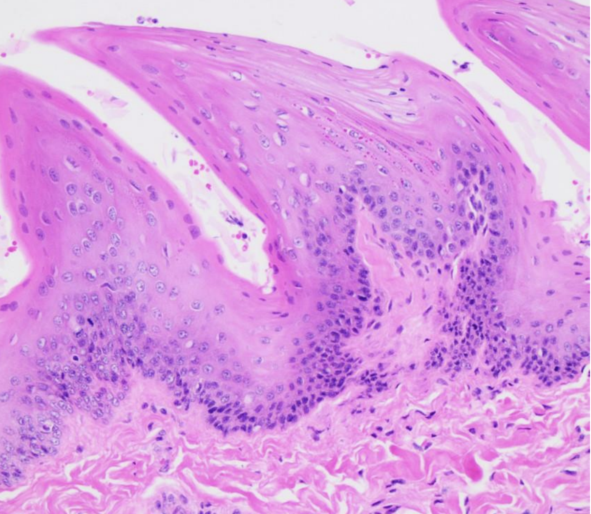 The Tongue is covered by a mucosa with what type of epithelium? 