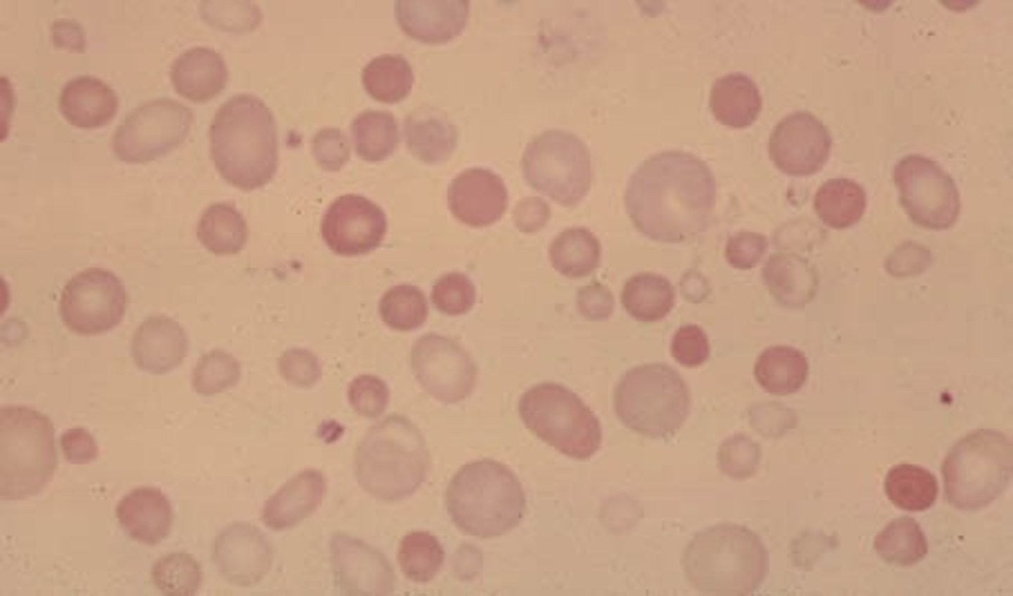 <p>Abnormal RBC size</p>