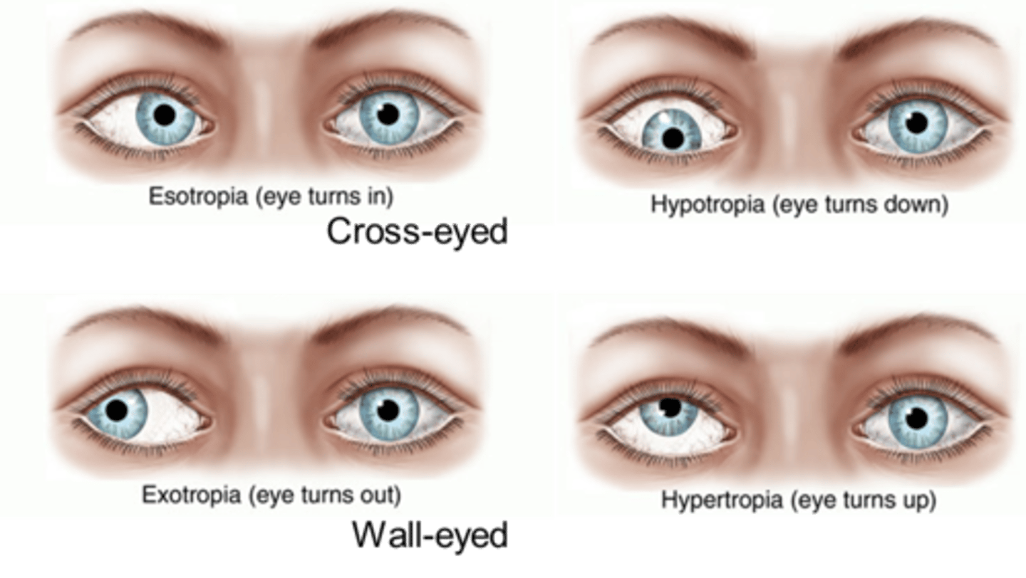 <p>cross-eyed/ misalignment of the eye</p>