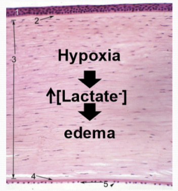 <p>There is an increase in anaerobic metabolism, causing a build up of lactate → oxmotic draw of water. the pH is also reduced → inhibits pump function and ion transport efficiency reduced. This causes <strong>edema</strong>. </p>