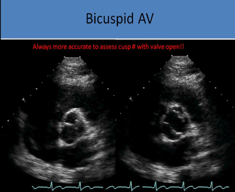 <p>in systole, the valve may appear normal in diastole and fused raphe cannot be detected without the valve open</p>