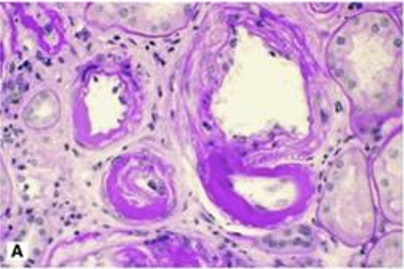 <p>What pathology is shown here?</p>