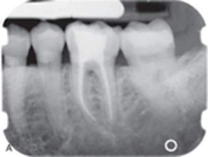 <p>What material is shown in the canals of tooth #19?***</p>