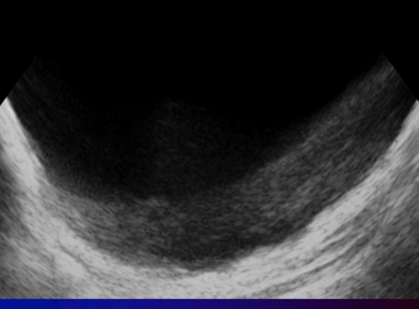 <p>What ultrasound artifact can be seen from <strong>imaging a 3D structure with anechoic fluid</strong>?</p>