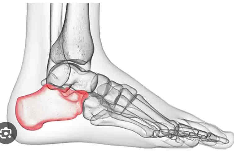 <p><strong><span>Calcaneal</span></strong></p>