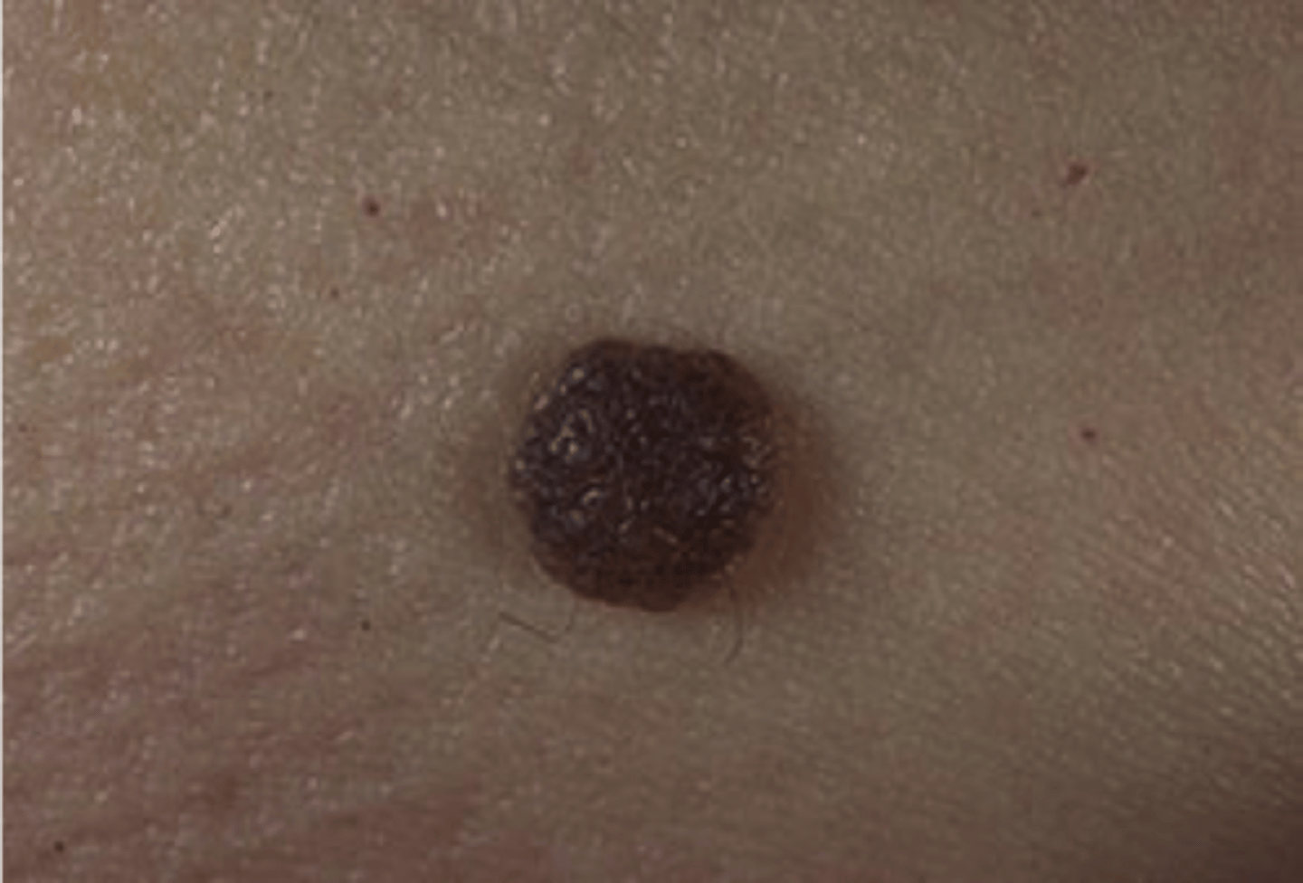 <p>which type of pigmented lesion:</p><p>• Common mole</p><p>• Benign proliferation of nevus</p><p>cells</p><p>• "Most common of all human</p><p>tumors"</p><p>extraoral:</p><p>• Asymptomatic</p><p>• Round</p><p>• Slightly raised</p><p>• Brown to black</p><p>• Uniformly pigmented</p><p>intraoral:</p><p>• Uncommon</p><p>• More than one in five intraoral</p><p>nevi lack pigmentation</p>