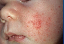 <p><strong>Neonatal Cephalic Pustulosis</strong></p><p>-Appears ______ ____ weeks of life (most commonly between 2-4 weeks)</p><p>-Inflammatory reaction to ____________ species&nbsp;</p><p>-Characterized by ___________ papules and pustules, _________<strong> of comedomes</strong>, and distribution limited to the face (especially cheeks) and scalp</p><p>-Spontaneously resolves within _ months&nbsp;</p><p>-Treatment → Medications are not always recommended for treatment</p><ul><li><p>________ with mild baby cleansers</p></li><li><p>Avoid oils and lotions</p></li><li><p>2% ___________ twice daily&nbsp;</p></li><li><p>1% hydrocortisone once daily (optional)&nbsp;</p></li></ul><p></p>