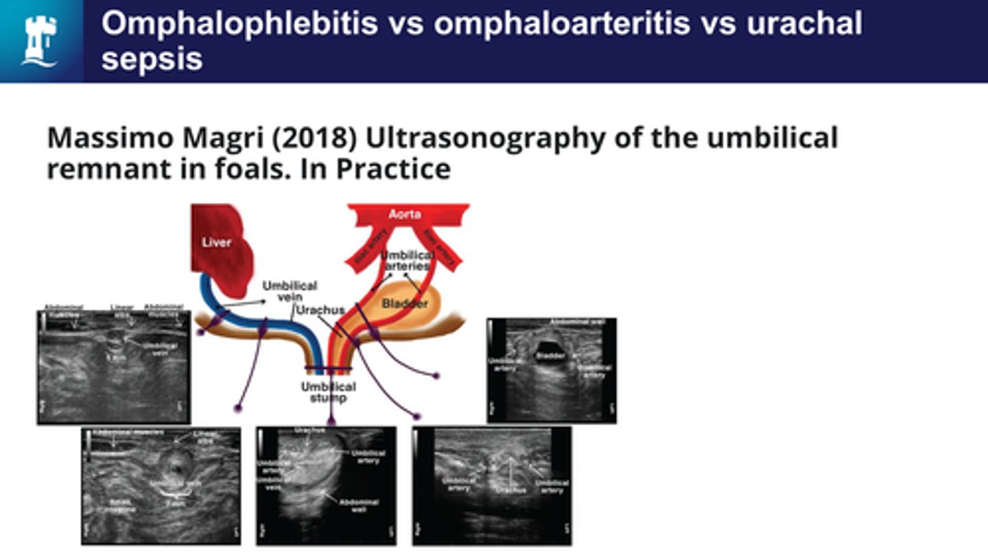<p>- Omphalophleblitis</p><p>- Omphaloarteritis</p><p>- Urachal sepsis</p><p>All of these are important because they are infections that are all associated with the internal structures associated with the umbilicus- any of these structures can become infected and cause sepsis.</p>